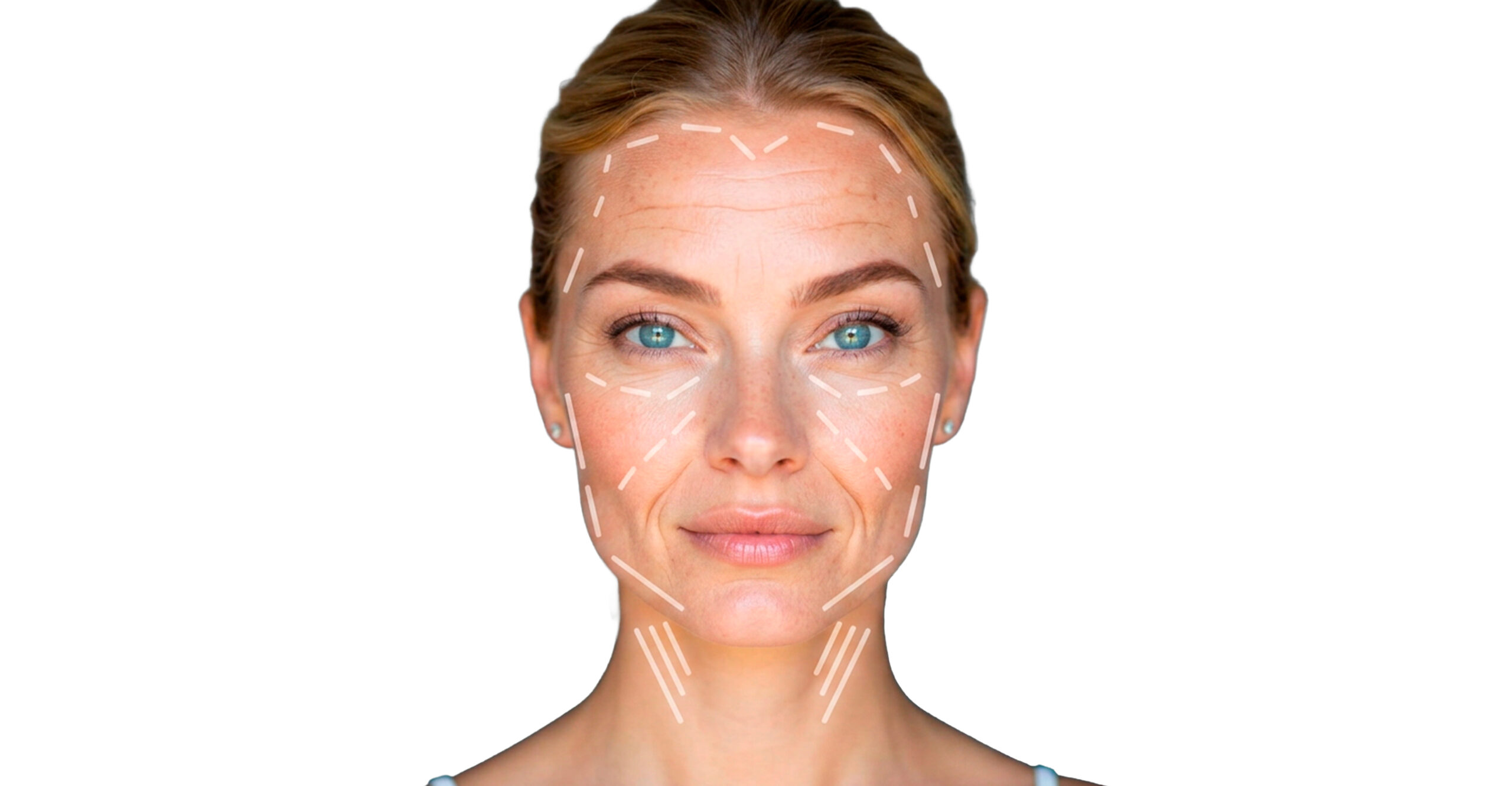 Lifting facial Bogotá