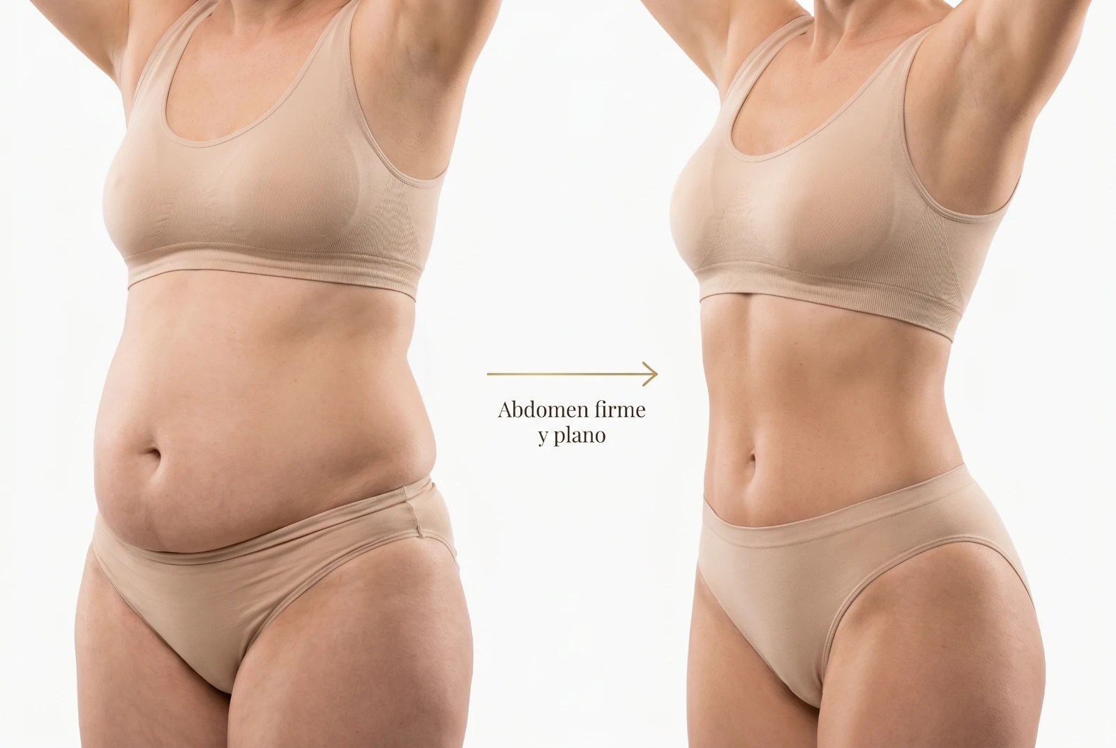 Abdominoplastia: antes y después