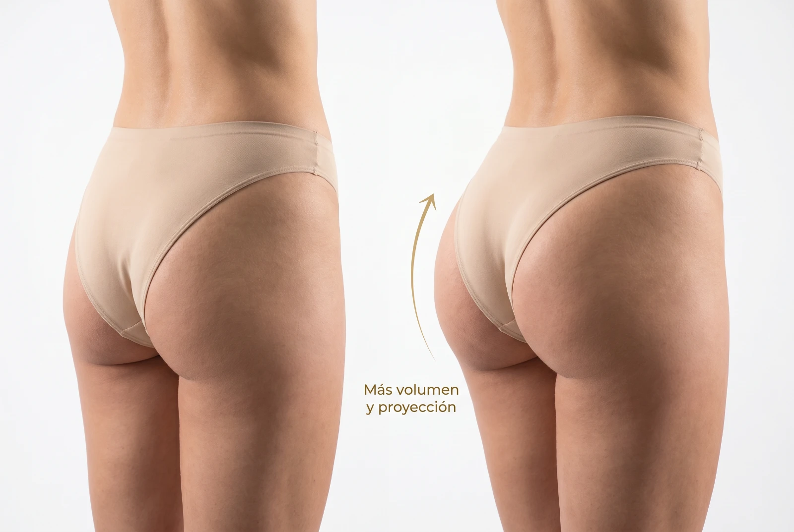 Gluteoplastia con implantes: antes y después