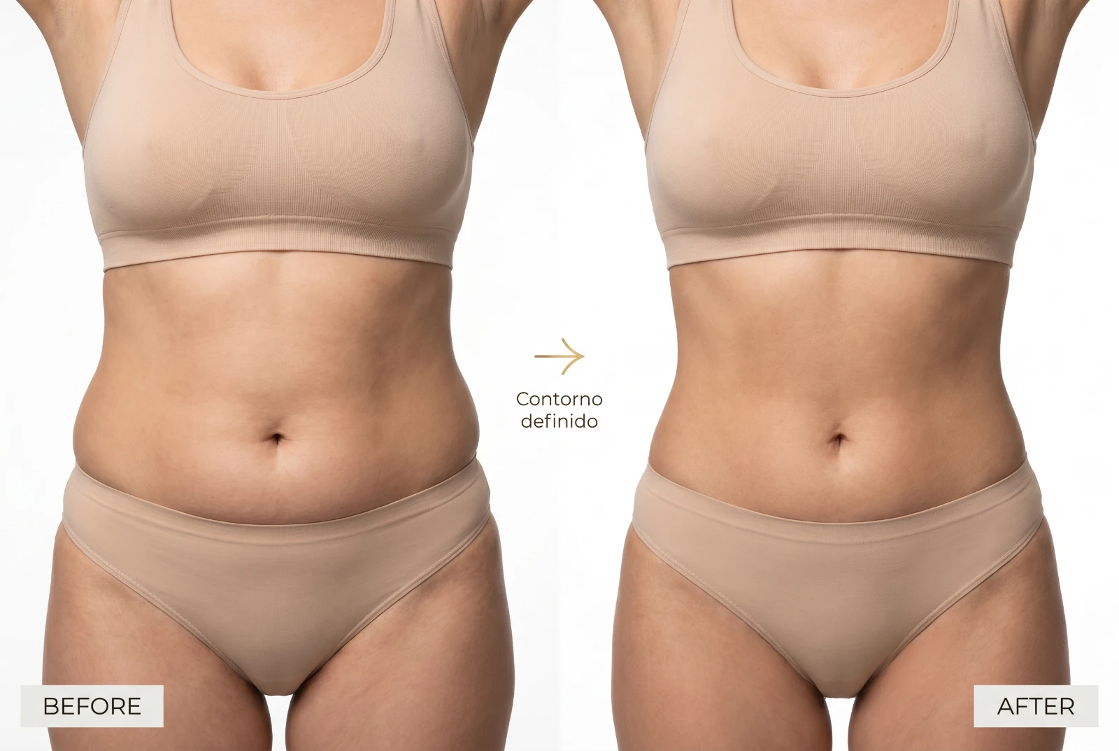 Liposucción: antes y después, contorno definido