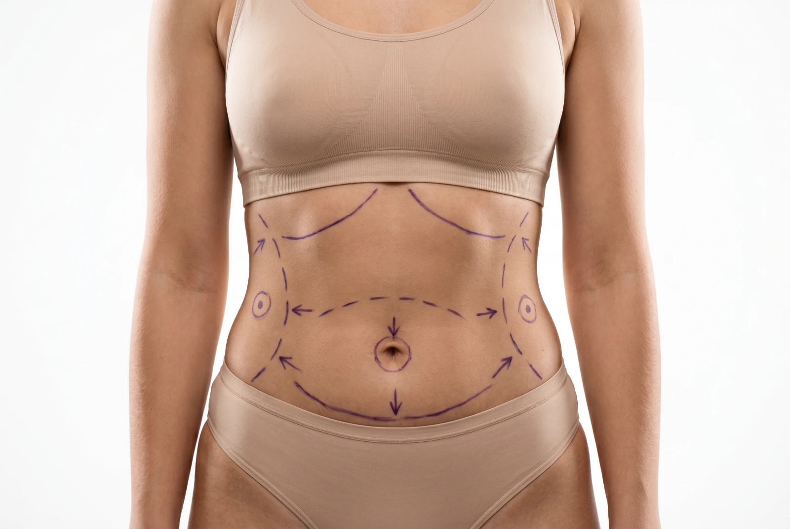 Marcación pre-quirúrgica de liposucción
