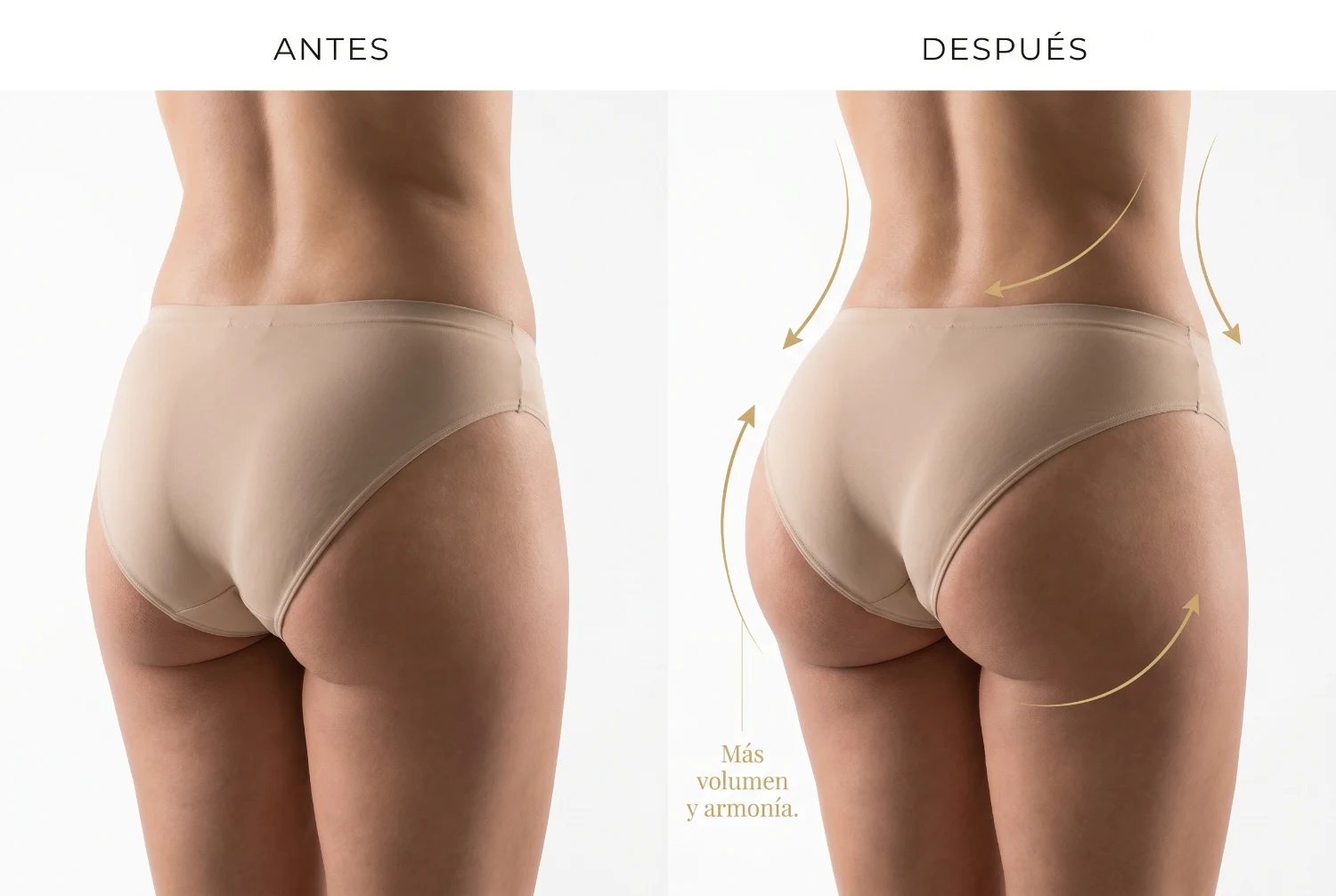 Lipotransferencia: antes y después