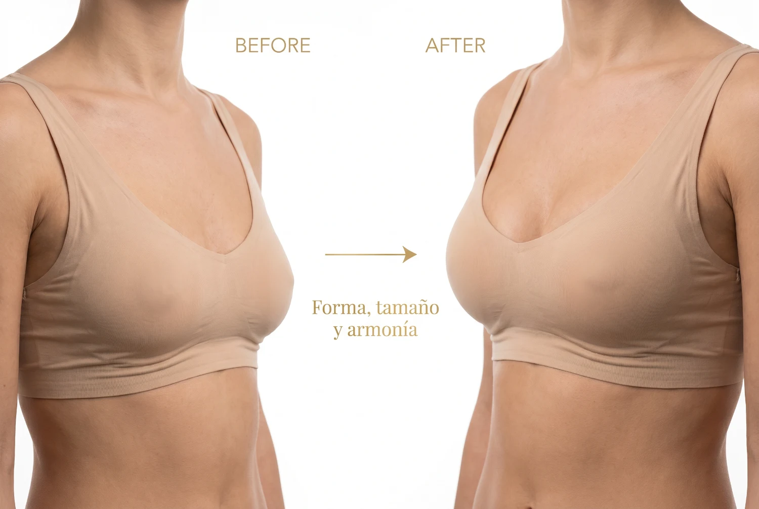 Mamoplastia: antes y después